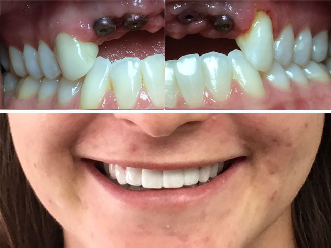 Missing Upper Teeth Before/After