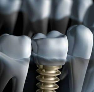 Dental Implants Pittsburgh PA