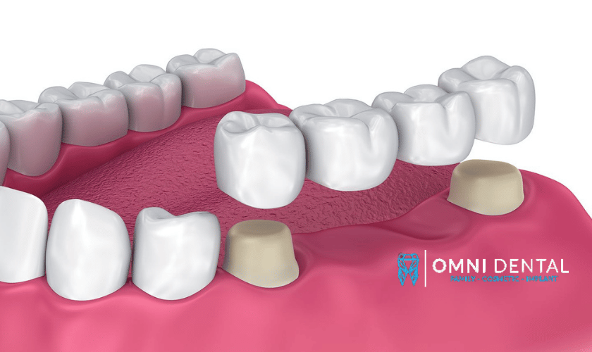 Advantages Of Dental Bridges.