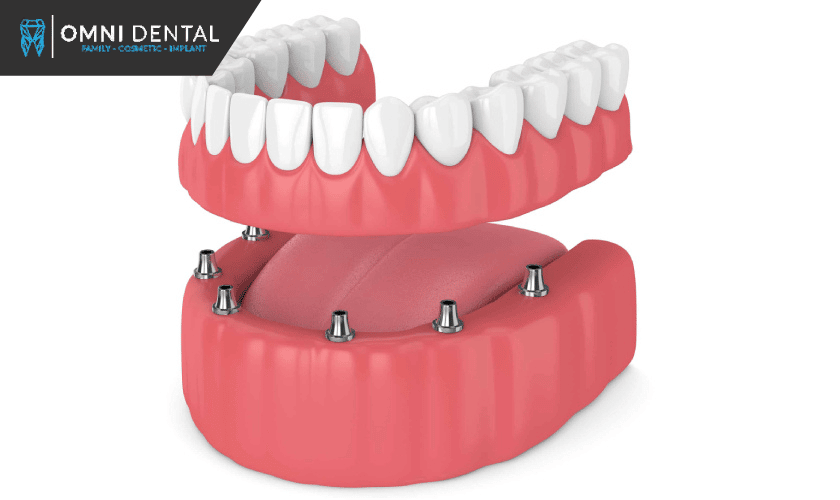 Overdentures Treatment