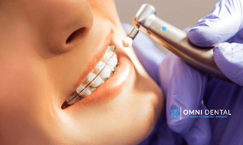 Teeth Whitening Treatment Shadyside.