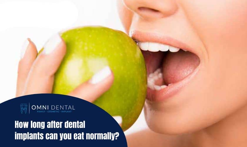 Eating Normally After Dental Implants