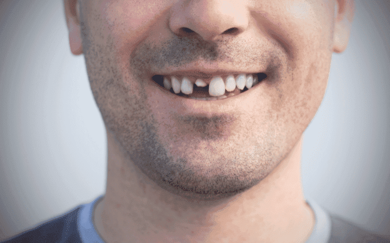 Why Are My Teeth Suddenly Chipping