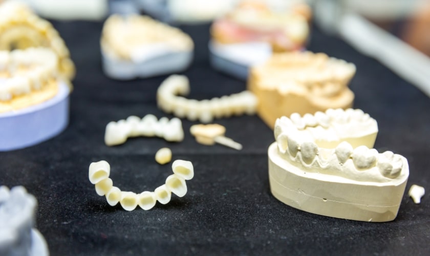 Dental Bridge Falls Out