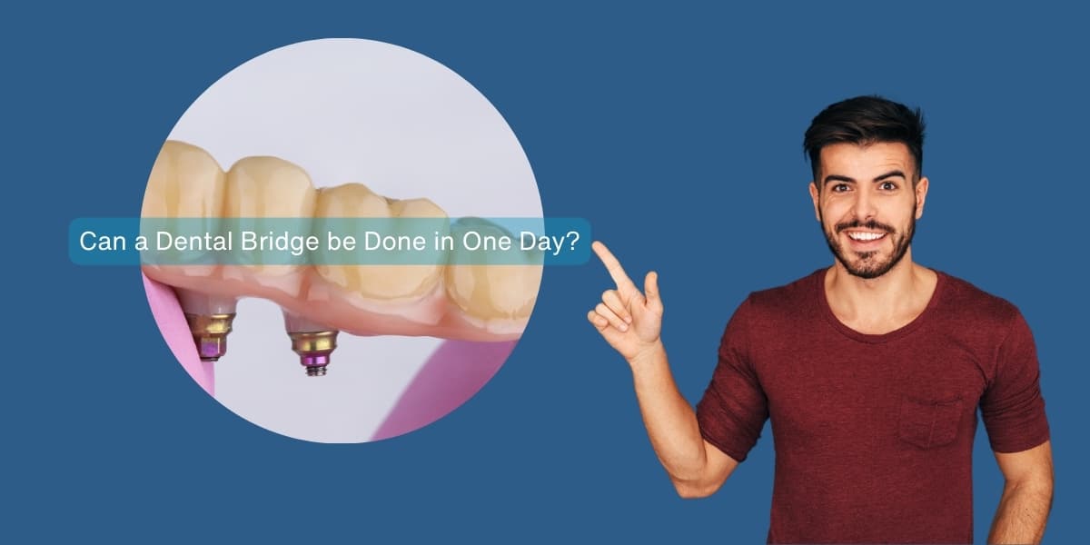 Can A Dental Bridge Be Done in One Day