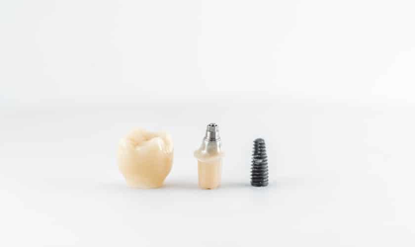 Restoring Dental Crowns for Dental Implants
