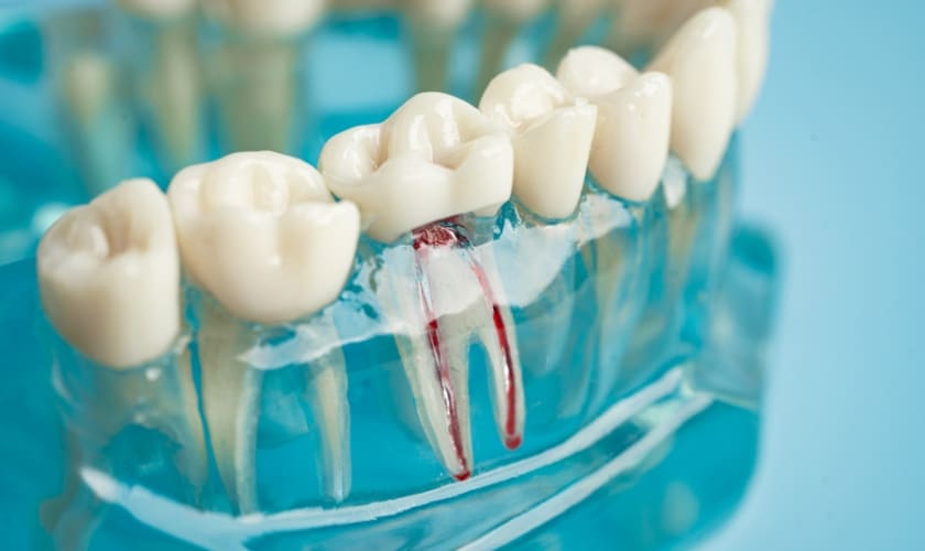 Root Canal Treatment