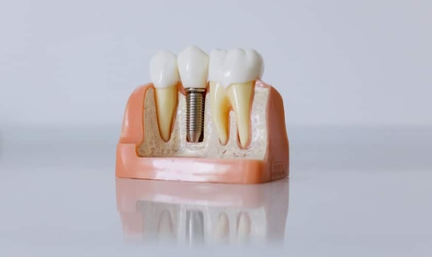 the essential dos and don’ts for caring for your dental implants