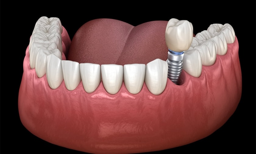 Understanding Dental Implant Surgery: Rewards And Recovery Tips