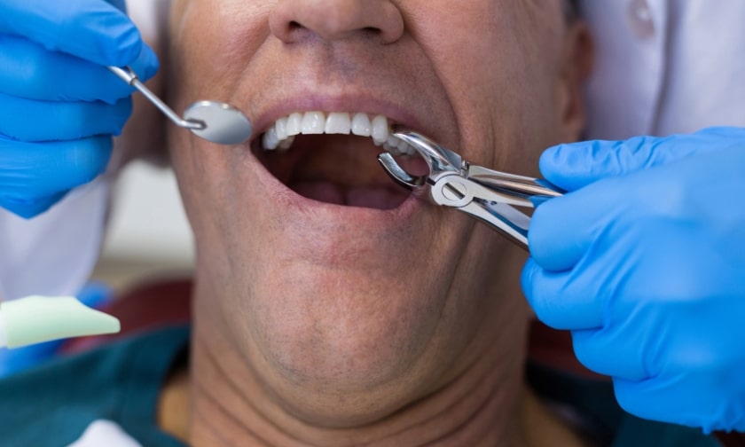 Wisdom Teeth Extraction: Benefits And Risks