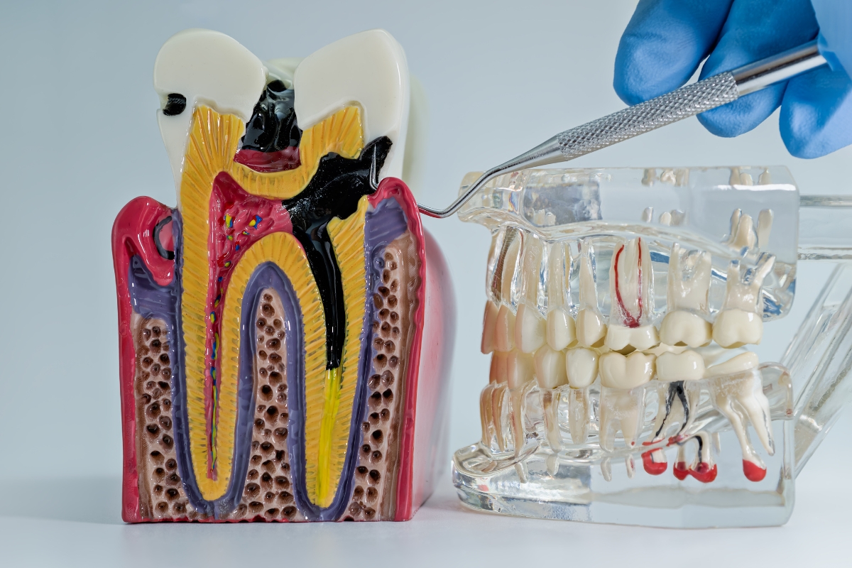 How to Manage Tooth Pain Before Your Root Canal in Pittsburgh