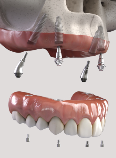 Dental Implant McMurray